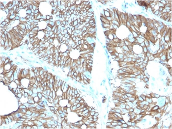 IHC staining of FFPE human colon with Cadherin 17 antibody (clone CDH17/2616). HIER: boil tissue sections in pH 9 10mM Tris with 1mM EDTA for 10-20 min and allow to cool before testing.