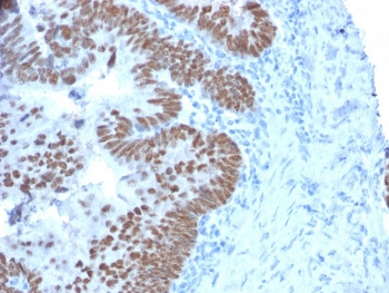 IHC testing of FFPE human colon carcinoma with CDX2 antibody (clone CDX2/2214). HIER: boil tissue sections in 10mM Tris with 1mM EDTA, pH 9, for 10-20 min followed by cooling prior to testing.