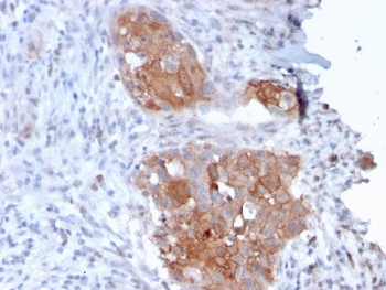 IHC testing of FFPE human bladder carcinoma with Desmoglein 1 antibody (clone 32-2B). HIER: boil tissue sections in pH 9 10mM Tris with 1mM EDTA for 10-20 min.