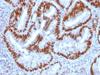 IHC staining of FFPE human endometrial carcinoma with Estrogen Receptor alpha antibody (clone 1D5). HIER: boil tissue sections in pH 9 10mM Tris with 1mM EDTA for 10-20 min and allow to cool before testing.