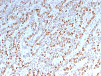 IHC staining of FFPE human breast carcinoma with Estrogen Receptor alpha antibody (clone ESR1/3342). HIER: boil tissue sections in pH 9 10mM Tris with 1mM EDTA for 10-20 min and allow to cool before testing.