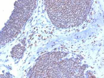 IHC staining of FFPE human breast carcinoma with biotin-conjugated ERa antibody (clone ESR1/3373). HIER: boil tissue sections in pH 9 10mM Tris with 1mM EDTA for 10-20 min and allow to cool before testing.