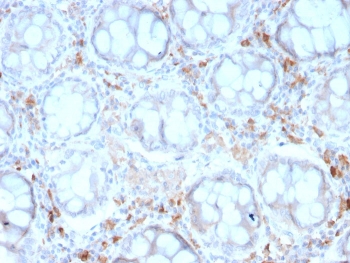 IHC staining of FFPE human colon carcinoma with recombinant CD209 antibody (clone rC209/1781). HIER: boil tissue sections in pH 9 10mM Tris with 1mM EDTA for 10-20 min and allow to cool before testing.