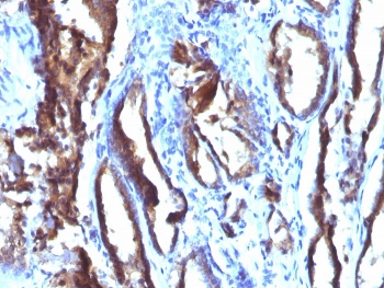 IHC staining of FFPE human prostate carcinoma with PSA antibody (clone 3E6). HIER: boil tissue sections in pH 9 10mM Tris with 1mM EDTA for 20 min and allow to cool before testing.