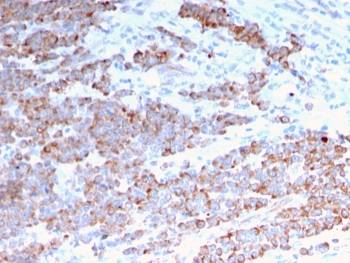 IHC staining of FFPE human colon carcinoma with recombinant Cytokeratin 18 antibody (clone rKRT18/1190). HIER: boil tissue sections in pH 9 10mM Tris with 1mM EDTA for 20 min and allow to cool before testing.
