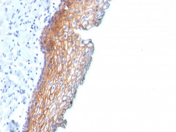 IHC staining of FFPE human esophageal carcinoma with Desmoglein 3 antibody (clone DSG3/2838). HIER: boil tissue sections in pH 9 10mM Tris with 1mM EDTA for 10-20 min and allow to cool before testing.