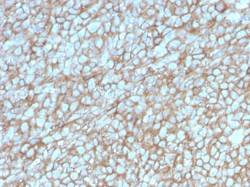 IHC staining of FFPE human melanoma with MCAM antibody (clone MCAM/3048). HIER: boil tissue sections in pH 9 10mM Tris with 1mM EDTA for 20 min and allow to cool before testing.