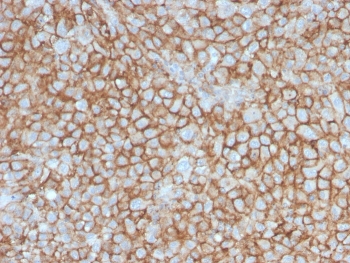 IHC staining of FFPE human melanoma with MCAM antibody (clone MCAM/3046). HIER: boil tissue sections in pH 9 10mM Tris with 1mM EDTA for 20 min and allow to cool before testing.