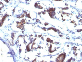 IHC staining of FFPE human gastric carcinoma with ZFYVE28 antibody (clone LST2/2426). HIER: boil tissue sections in pH 9 10mM Tris with 1mM EDTA for 20 min and allow to cool before testing.