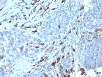 IHC staining of FFPE human tumor with recombinant IgM antibody (clone IGHM/3135R). HIER: boil tissue sections in pH 9 10mM Tris with 1mM EDTA for 10-20 min and allow to cool before testing.