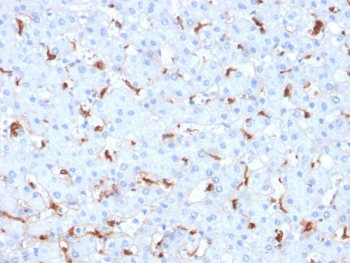 IHC staining of FFPE human hepatocellular carcinoma with C1QB antibody (clone C1QB/2961). HIER: boil tissue sections in pH 9 10mM Tris with 1mM EDTA for 20 min and allow to cool before testing.