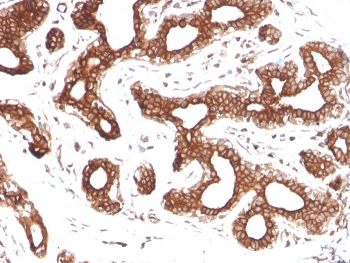 IHC staining of FFPE human breast carcinoma with Calpastatin antibody (clone CAST/1550). HIER: boil tissue sections in pH 9 10mM Tris with 1mM EDTA for 20 min and allow to cool before testing.