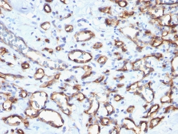 IHC staining of FFPE human angiosarcoma with CD34 antibody. HIER: boil tissue sections in pH 9 10mM Tris with 1mM EDTA for 20 min and allow to cool before testing.