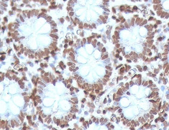 IHC testing of FFPE human colon carcinoma with CDX2 antibody (clone CTHP2-1). HIER: boil sections in pH 9 10mM Tris with 1mM EDTA for 10-20 min.