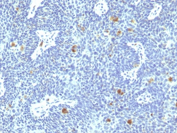 IHC staining of FFPE human cervix with HPV-16 E6 antibody. HIER: boil tissue sections in pH 9 10mM Tris with 1mM EDTA for 20 min and allow to cool before testing.