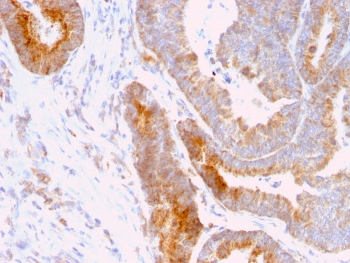 IHC staining of FFPE human colon carcinoma with Thomsen-Friedenreich Antigen antibody (clone A84-A/F10). HIER: boil tissue sections in pH 9 10mM Tris with 1mM EDTA for 20 min and allow to cool before testing.