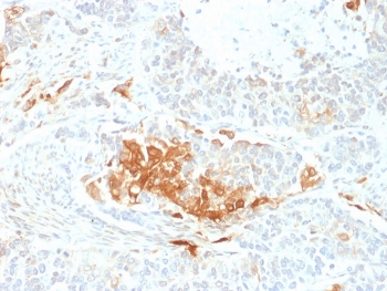 IHC staining of FFPE human neuroendocrine tumor with NSE antibody (clone ENO2/2706). HIER: boil tissue sections in pH 9 10mM Tris with 1mM EDTA for 20 min and allow to cool before testing.
