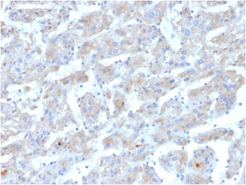 IHC staining of FFPE human liver with APOB antibody. HIER: boil tissue sections in pH 9 10mM Tris with 1mM EDTA for 20 min and allow to cool before testing.