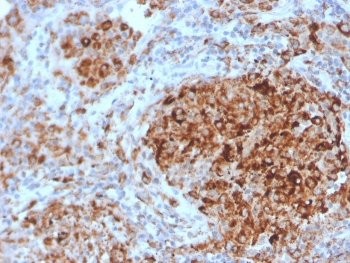 IHC staining of FFPE human lymph node with TIM3 antibody (clone TIM3/4028). HIER: boil tissue sections in pH 9 10mM Tris with 1mM EDTA for 20 min and allow to cool before testing.