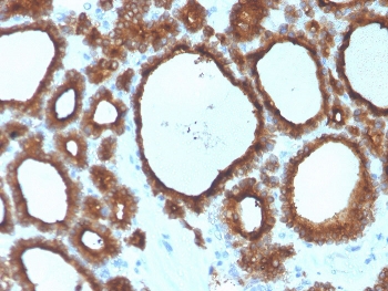 IHC staining of FFPE human thyroid carcinoma with Thyroid Peroxidase antibody. HIER: boil tissue sections in pH 9 10mM Tris with 1mM EDTA for 20 min and allow to cool before testing.