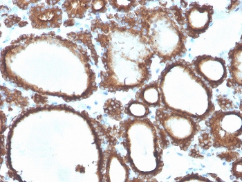 IHC staining of FFPE human thyroid carcinoma with TPO antibody. HIER: boil tissue sections in pH 9 10mM Tris with 1mM EDTA for 20 min and allow to cool before testing.