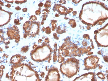 IHC staining of FFPE human thyroid carcinoma with TPO antibody. HIER: boil tissue sections in pH 9 10mM Tris with 1mM EDTA for 20 min and allow to cool before testing.