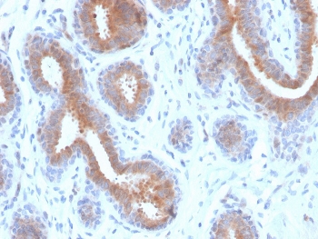 IHC staining of FFPE human breast carcinoma with recombinant Mammaglobin antibody (clone rMGB/4299). HIER: boil tissue sections in pH 9 10mM Tris with 1mM EDTA for 20 min and allow to cool before testing.