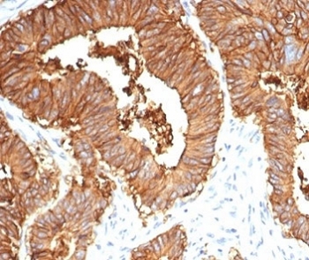 IHC staining of FFPE human colon tissue with recombinant EpCAM antibody (clone EGP40/7035R). HIER: boil tissue sections in pH 9 10mM Tris with 1mM EDTA for 20 min and allow to cool before testing.