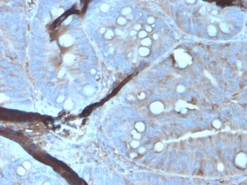 IHC staining of FFPE human colon carcinoma tissue with MERTK antibody (clone MERTK/3023). HIER: boil tissue sections in pH 9 10mM Tris with 1mM EDTA for 20 min and allow to cool before testing.