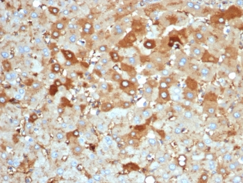 IHC staining of FFPE human liver carcinoma in colon tissue with Albumin antibody (clone rALB/6414). HIER: boil tissue sections in pH 9 10mM Tris with 1mM EDTA for 20 min and allow to cool before testing.