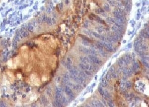 IHC: Formalin-fixed, paraffin-embedded human colon carcinoma stained with IgA Secretory Component antibody (SPM217).