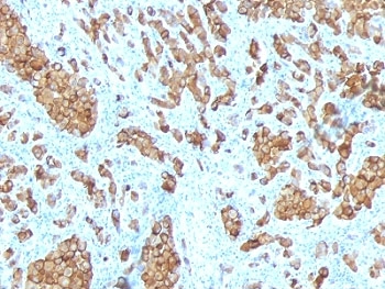 IHC: Formalin-fixed, paraffin-embedded human melanoma stained with anti-Melan-A antibody (SPM342).