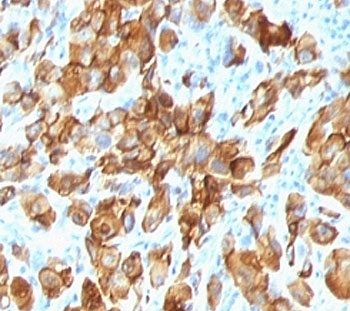 IHC: Formalin-fixed, paraffin-embedded human melanoma stained with anti-MART-1 antibody (SPM540).