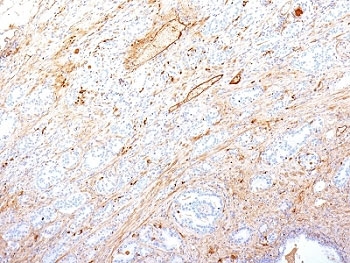 IHC: Formalin-fixed, paraffin-embedded human pancreatic adenocarcinoma stained with Fibronectin antibody (SPM246).