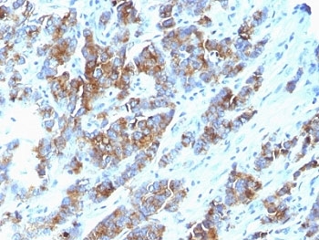 IHC: Formalin-fixed, paraffin-embedded human breast carcinoma stained with Mucin-1 antibody (clone SPM533).
