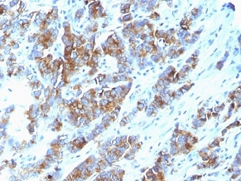IHC: Formalin-fixed, paraffin-embedded human breast carcinoma stained with Mucin-1 antibody (clone SPM533).