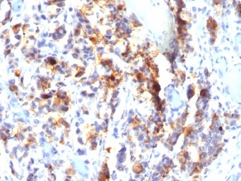 IHC: Formalin-fixed, paraffin-embedded human gastric carcinoma stained with Mucin-5AC antibody (SPM297).