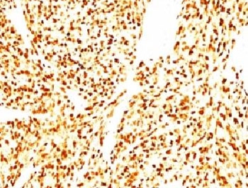 Formalin-fixed, paraffin-embedded human Rhabdomyosarcoma stained with anti-MyoD1 antibody (SPM427)