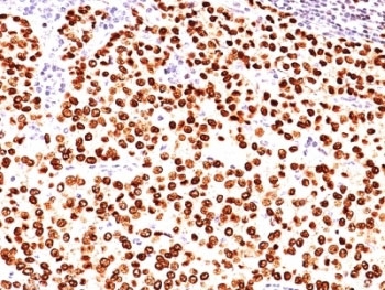 IHC: Formalin-fixed, paraffin-embedded human breast carcinoma stained with anti-Progesterone Receptor antibody (clone SPM566).