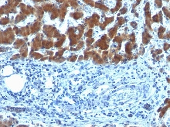 IHC: Formalin-fixed, paraffin-embedded human hepatocellular carcinoma stained with RBP (clone SPM442).