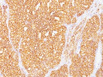 IHC: Formalin-fixed, paraffin-embedded human renal cell carcinoma stained with Carbonic Anhydrase IX antibody (SPM487).