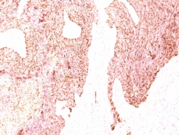 IHC: Formalin-fixed, paraffin-embedded human small cell lung carcinoma stained with Chromogranin A antibody (SPM339)