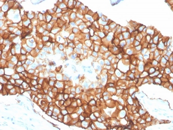 IHC staining of FFPE human breast carcinoma tissue with recombinant ErbB2 antibody (clone ERBB2/4376R) at 2ug/ml in PBS for 30min RT. HIER: boil tissue sections in pH 9 10mM Tris with 1mM EDTA for 20 min and allow to cool before testing.