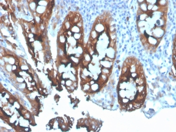 IHC staining of FFPE human colon carcinoma tissue with CEA antibody. HIER: boil tissue sections in pH 9 10mM Tris with 1mM EDTA for 20 min and allow to cool before testing.