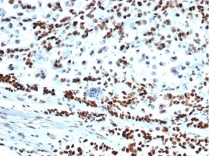 IHC staining of FFPE human colon carcinoma tissue with recombinant MSH6 antibody (clone MSH6/6654R). HIER: boil tissue sections in pH 9 10mM Tris with 1mM EDTA for 20 min and allow to cool before testing.