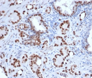 IHC staining of FFPE human prostate carcinoma tissue with recombinant AR antibody (clone rDHTR/6818) at 2ug/ml in PBS for 30min RT. HIER: boil tissue sections in pH 9 10mM Tris with 1mM EDTA for 20 min and allow to cool before testing.