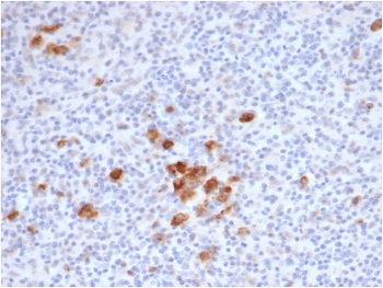 IHC staining of FFPE human Hodgkins lymphoma tissue with recombinant CD30 antibody (clone rKi-1/6913) at 2ug/ml in PBS for 30min RT. Staining of Reed-Sternberg cells is observed. HIER: boil tissue sections in pH 9 10mM Tris with 1mM EDTA for 20 min and allow to cool before testing.