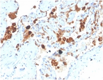 IHC staining of FFPE human lung tissue with Surfactant Protein D antibody (clone SFTPD/4363). HIER: boil tissue sections in pH 9 10mM Tris with 1mM EDTA for 20 min and allow to cool before testing.