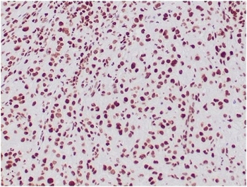 IHC staining of FFPE human epithelioid sarcoma with INI1 antibody (clone SMARCB1/3984). HIER: boil tissue sections in pH 9 10mM Tris with 1mM EDTA for 20 min and allow to cool before testing.