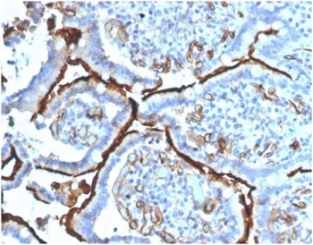 IHC staining of FFPE human colon carcinoma tissue with Angiotensin Converting Enzyme antibody (clone ACE/3764) at 2ug/ml in PBS for 30min RT. HIER: boil tissue sections in pH 9 10mM Tris with 1mM EDTA for 20 min and allow to cool before testing.